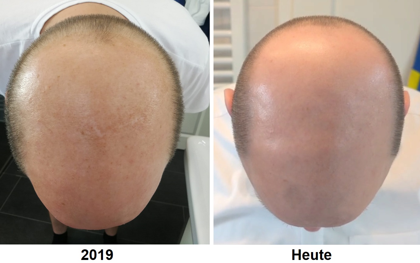 Kopfhautvergleich von Jörg Abel: Aufnahme von 2019 und spätere Aufnahme